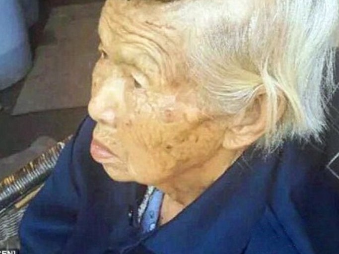 Old Lady Thought It Was Just A Mole On Her Head, Nope It Grew Into A Giant Horn (Maybe NSFL?)