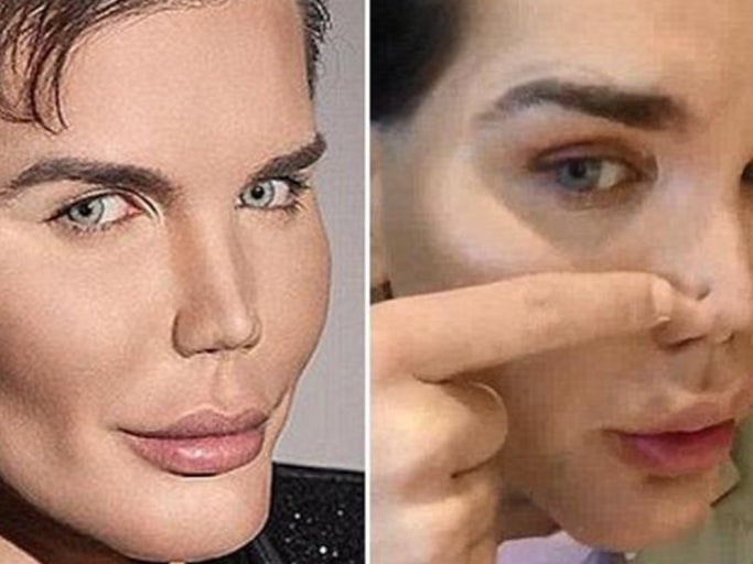 Dude Who Gets $300,000 Worth Of Surgery To Look Like A Ken Doll Has His Nose Collapse And Reject His Body