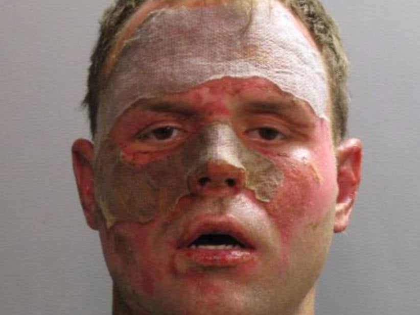 Florida Man Smartly Smoked Crack After His Face Was Burned By A Car Fire