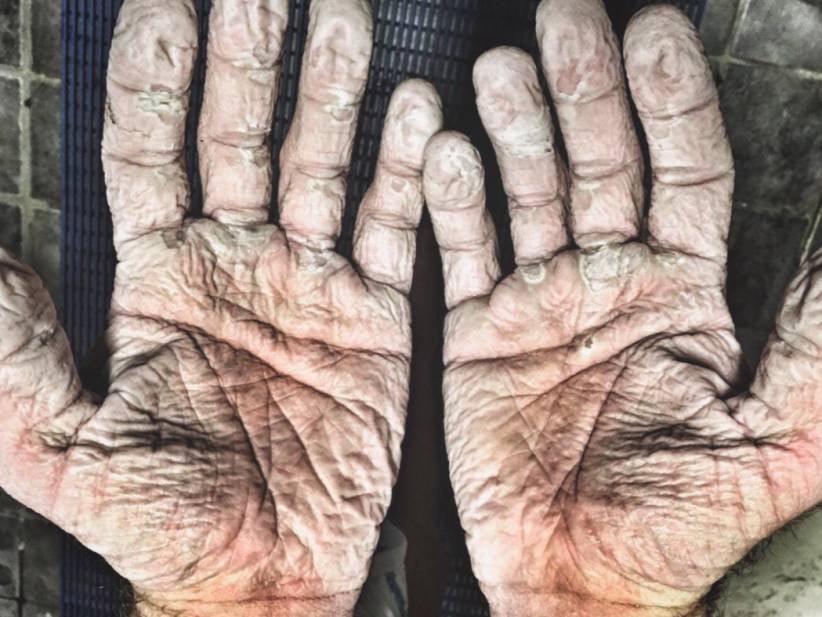 Olympic Rower's Hands Age 400 Years During His Failed Expedition To Row To The North Pole